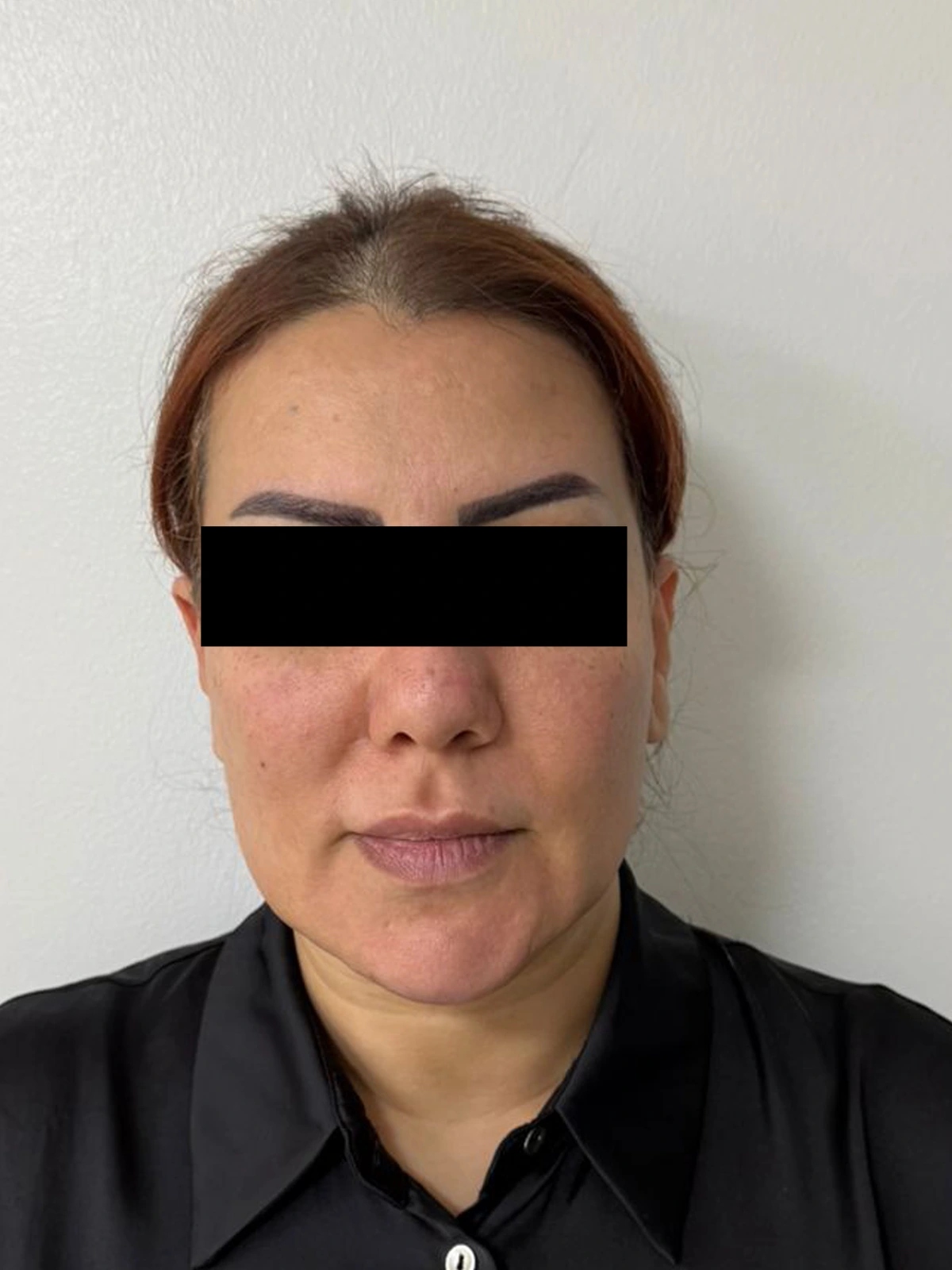 Deep Plane Facelift — before