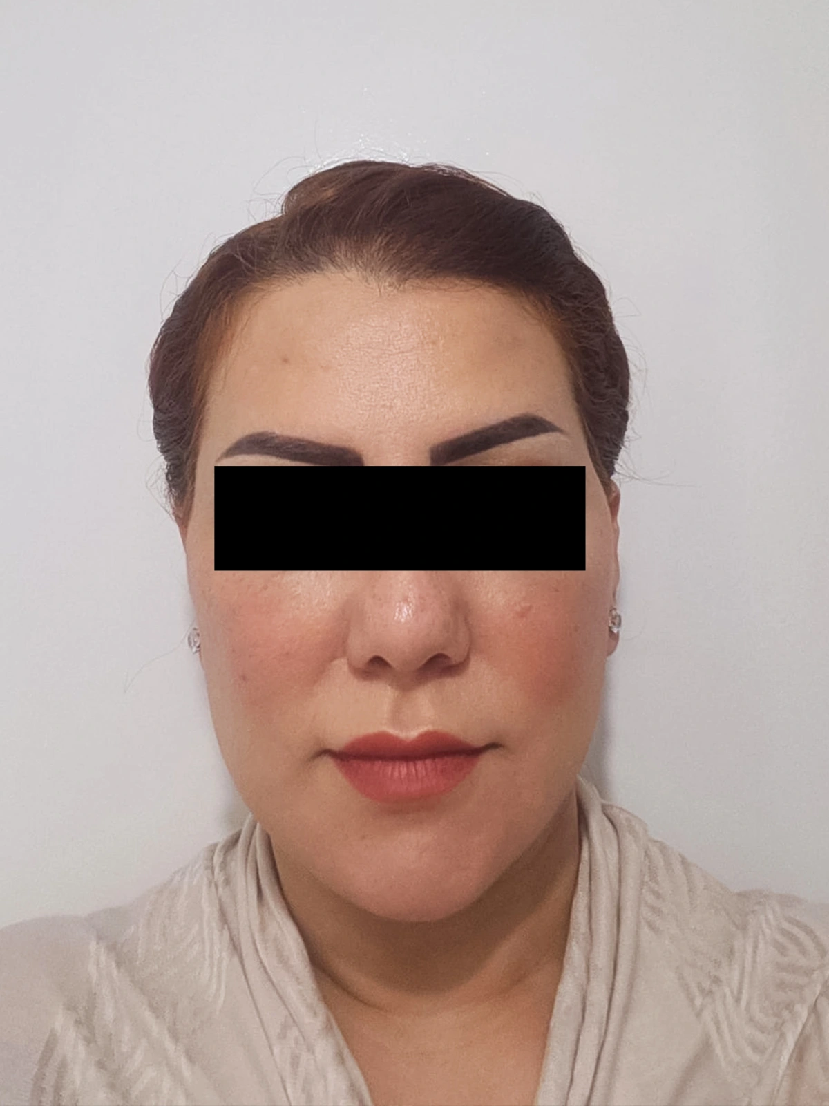 Deep Plane Facelift — after