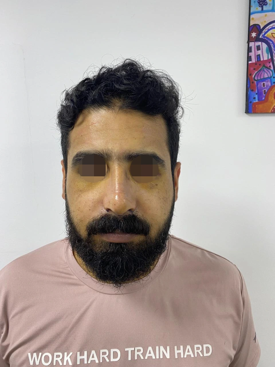Rhinoplasty — after