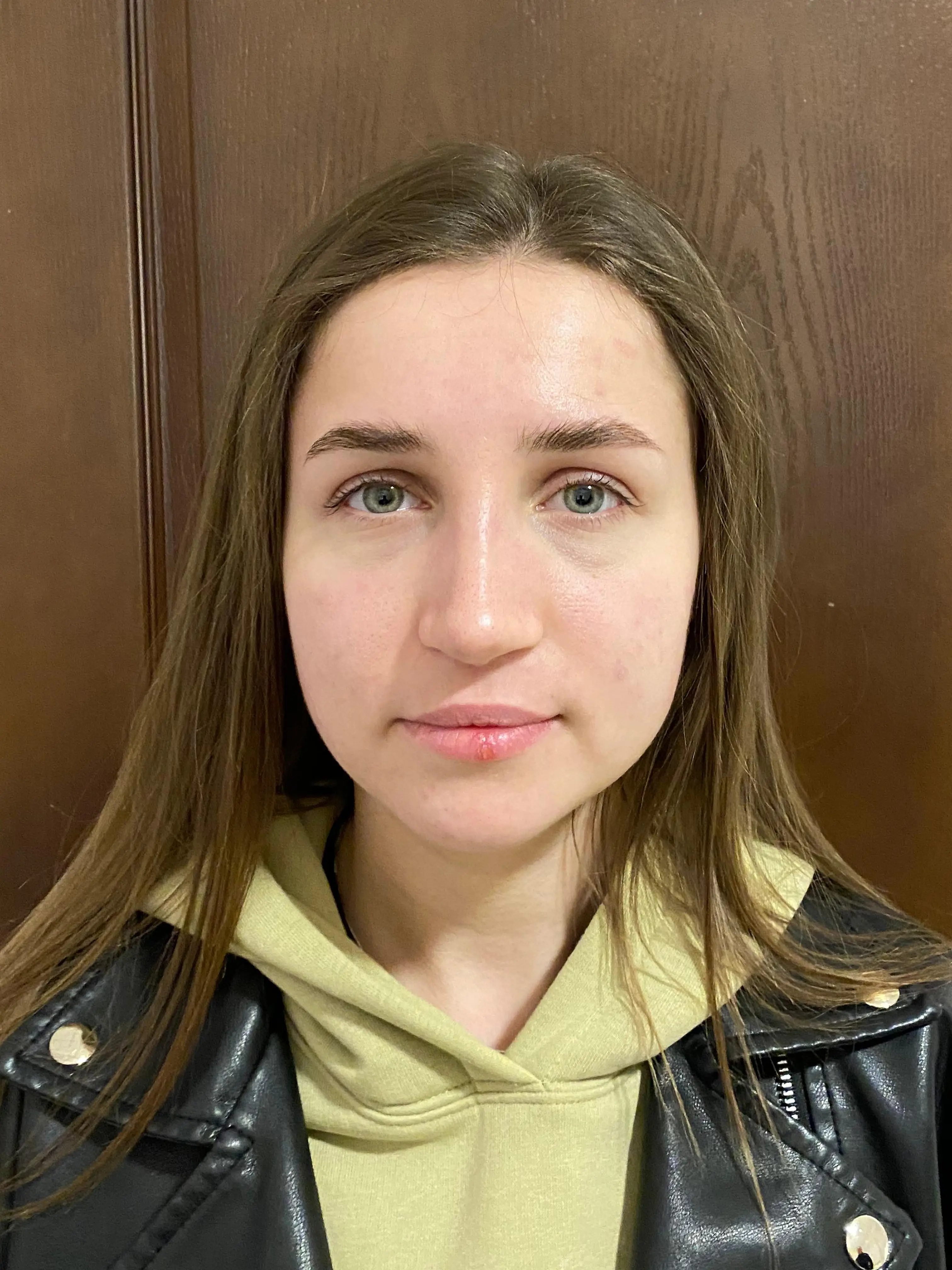 Rhinoplasty — after