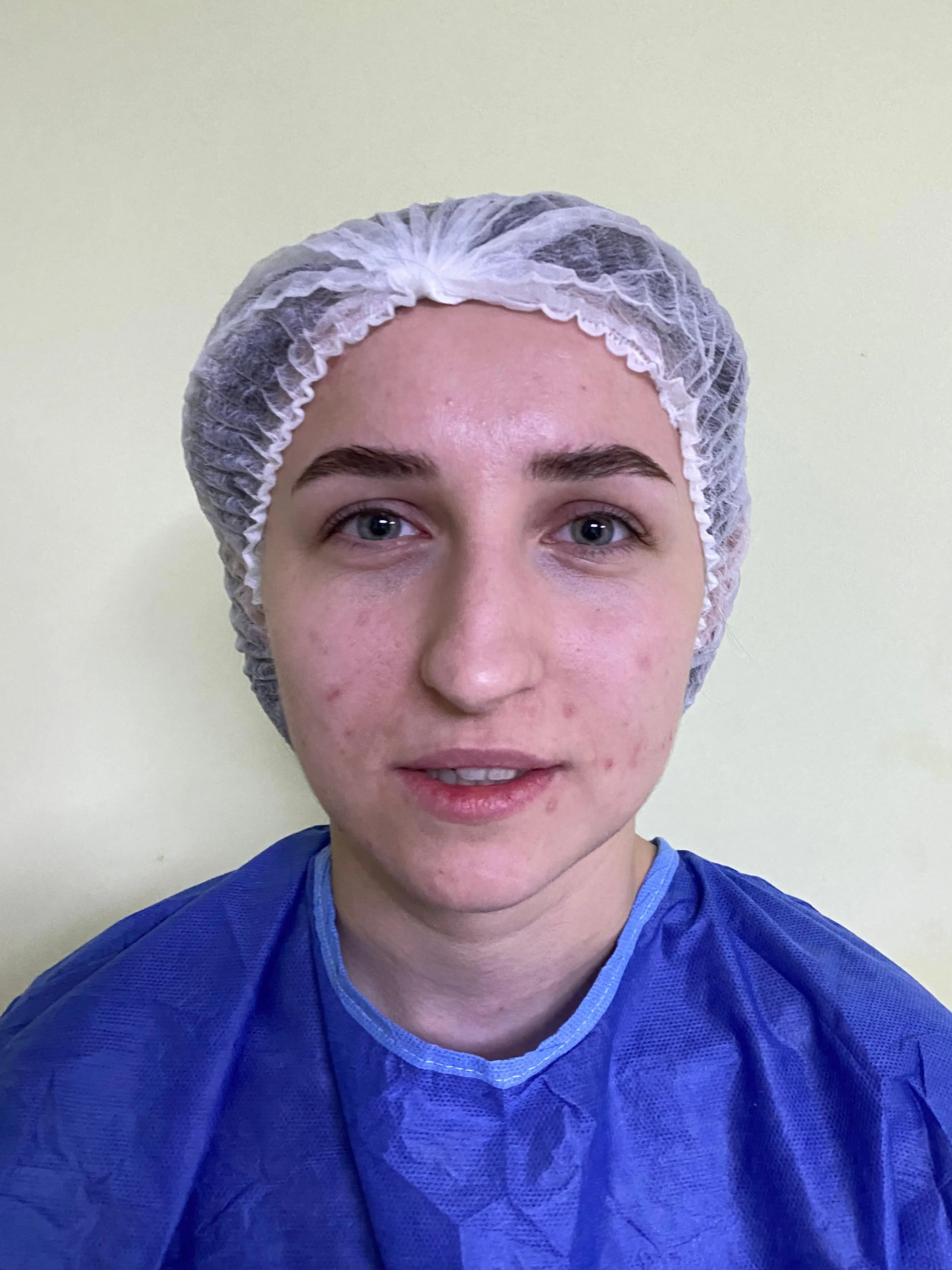 Rhinoplasty — before