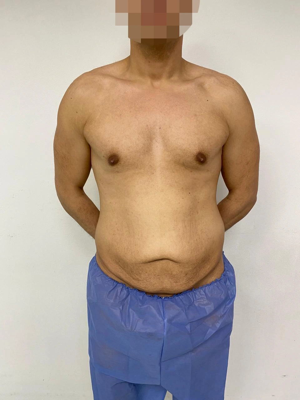 Tummy Tuck — before